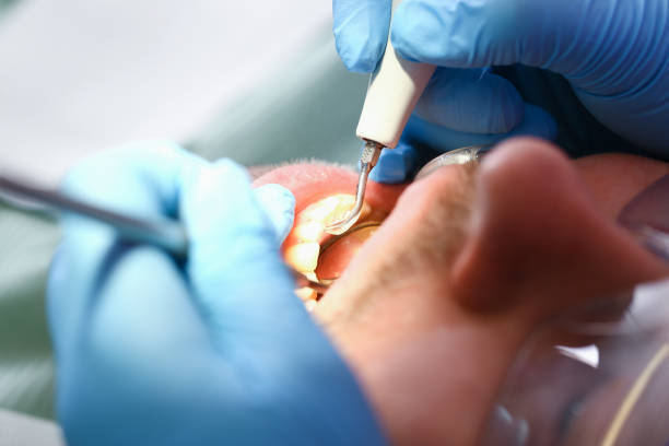 Best Emergency Tooth Extraction in Durand, IL