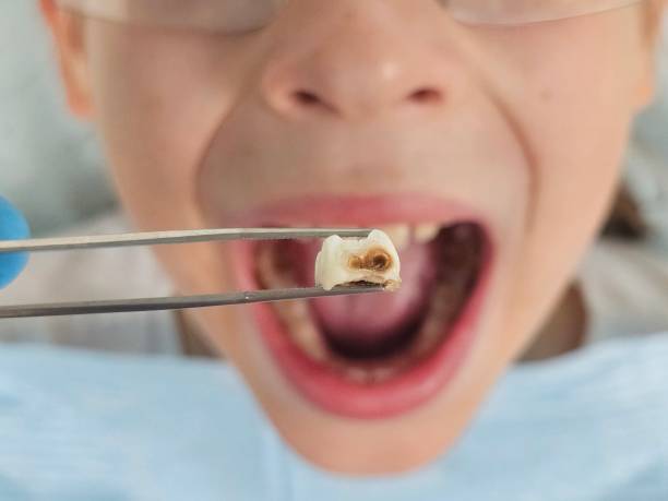 Best Emergency Tooth Extraction in Durand, IL